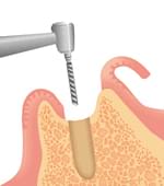 顎の骨にドリルで、人工歯根を埋め込むための孔(あな)を開ける。