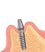義歯の支えとなるねじを、人工歯根の上に入れる。