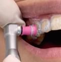 ホワイトニングについての説明/歯の表面をクリーニング